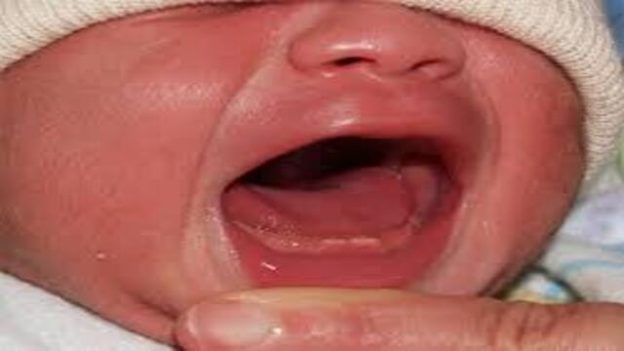 Bayi Lahir dengan Gigi Lengkap